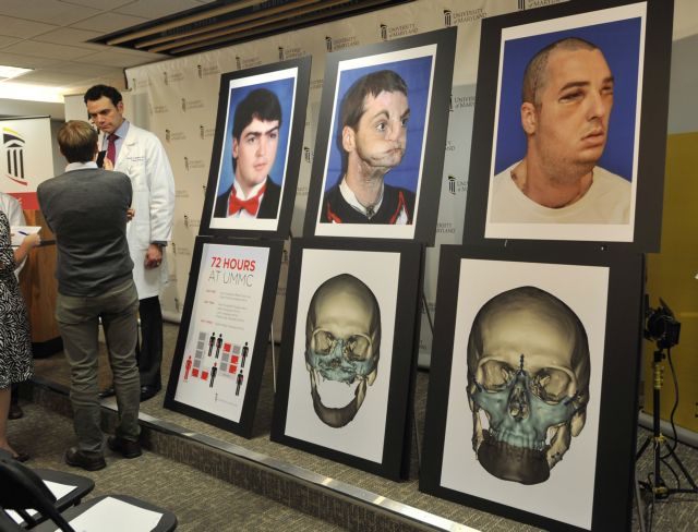 Την «τελειότερη» μεταμόσχευση προσώπου παρουσίασαν γιατροί στις ΗΠΑ